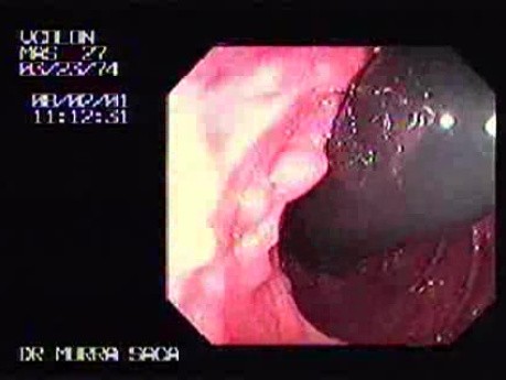 Familial Adenomatous Polyposis of the Colon (13 of 29)