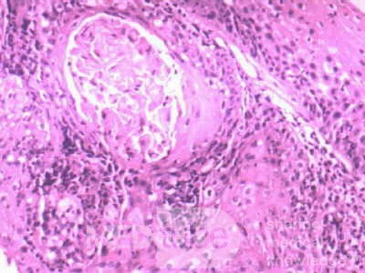 Distal Esophageal Squamous Cell Carcinoma (24 of 28)