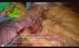 ICG His Sleeve Gastrectomy