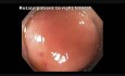 Colonoscopy Goes Awry - Cecal EMR Bleed - clip D