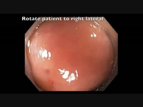 Colonoscopy Goes Awry - Cecal EMR Bleed - clip D