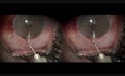 Juvenile Glaucoma - Microtrack Filtration
