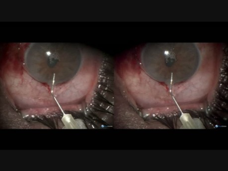 Juvenile Glaucoma - Microtrack Filtration