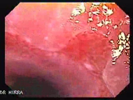 Barrett Esophagus Magnifying Endoscopy (5 of 6)