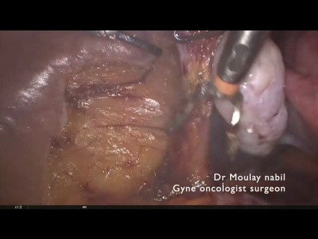 Didactic Hysterectomy for Endometrial Cancer