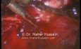 Resection of Right Adrenal Mass - Laparoscopy