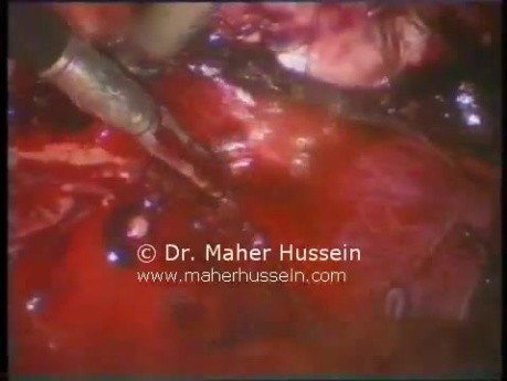 Resection of Right Adrenal Mass - Laparoscopy