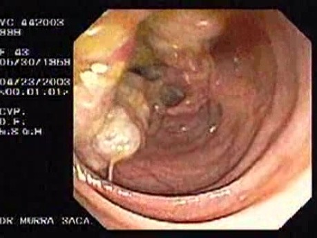 Submucosal Mass