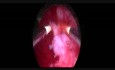 Hysteroscopy Broken IUD Extraction