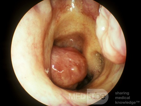 Large Inverting Papilloma Extending into Choana