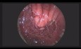 A New Repair Method for Rectovesical Fistula: Overlapping Rectal Muscle-plasty by TEM (Transanal Endoscopic Microsurgery)