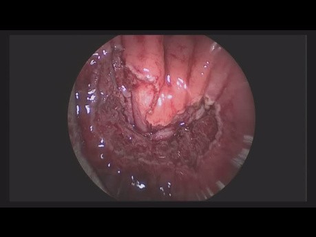 A New Repair Method for Rectovesical Fistula: Overlapping Rectal Muscle-plasty by TEM (Transanal Endoscopic Microsurgery)