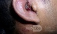 Ramsay Hunt Syndrome