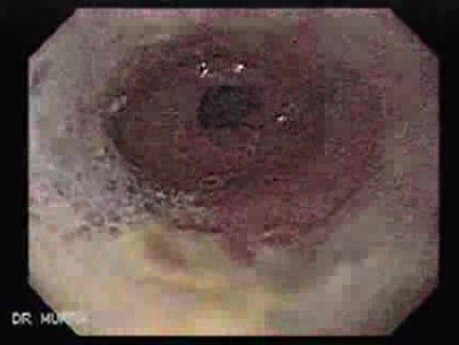 Distal Esophageal Tumor - Esophagoscopy