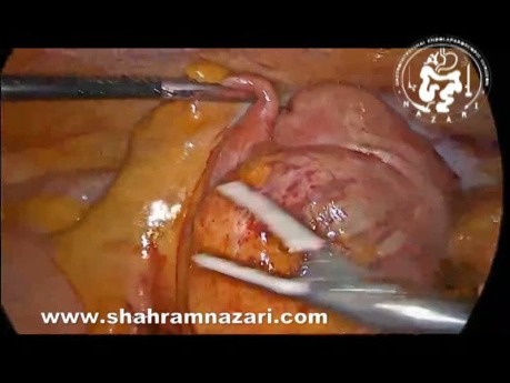 Laparoscopic Right Hemicolectomy for Mucinous Appendiceal Adenocarcinoma Diagnosed After Routine Appendectomy 
