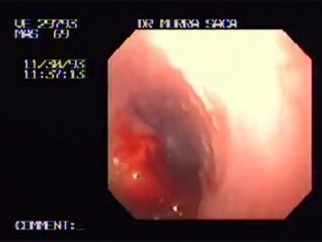 Squamous Cell Carcinoma of the Cardias (2 of 2 )