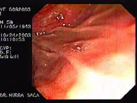 Adenocarcinoma of Papilla of Vater (4 of 4)