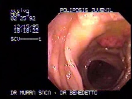 Non Familial Juvenile Polyposis Of The Colon (4 of 37)