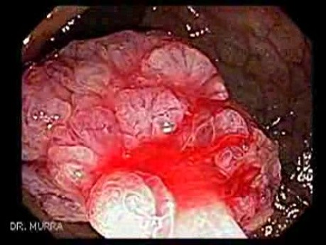 Giant Tubulo - Villous Adenoma (12 of 17)