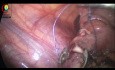 Laparoscopic Appendectomy for 12yrs Old Boy