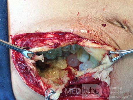 Liver H Disease