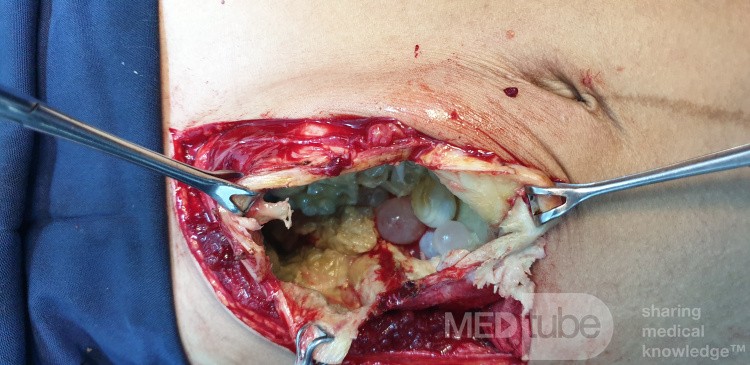 Liver H Disease
