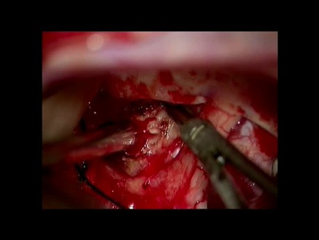 Transcranial Approach to Remove the Pituitary Tumor