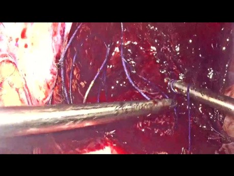 Ruptured of Uterus at Scar Site & MTP in Case of Previous 2 LSCS with Scar Ectopic Pregnancy