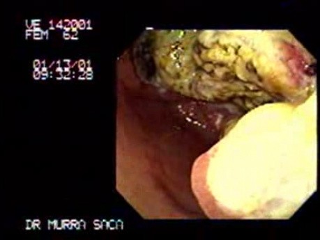 Gastric Adenocarcinoma - Obstruction - Endoscopy