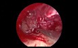 Endoscopic Revision Tympanoplasty for Conductive Hearing Loss