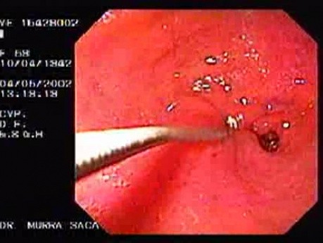 Gastric Adenocarcinoma of the Antrum - Endoscopy (2 of 2 )