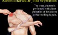 Shoulder Separation - Acromioclavicular Joint - Video Lecture