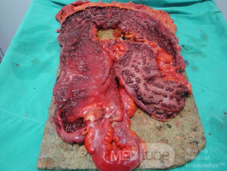 Multiple Rectal Ulcers (96 of 110)