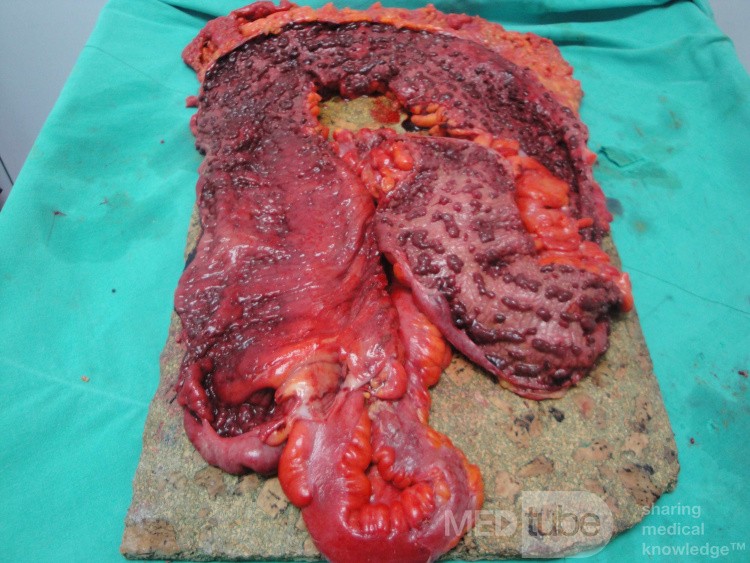 Multiple Rectal Ulcers (96 of 110)