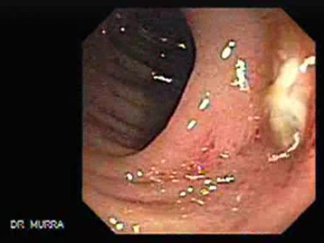 Diverticulitis (4 of 4)