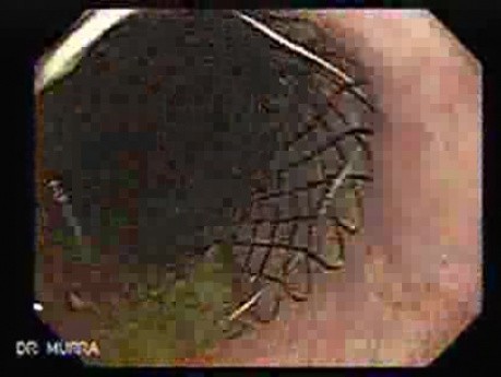 Post Esophageal Stenting - Esophagpscopy