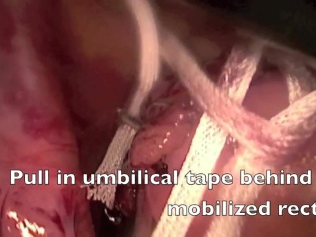 Laparoscopic rectopexy