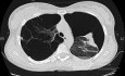 Spontaneous Pneumothorax In Patient With Emphysema
