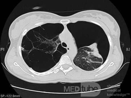 Spontaneous Pneumothorax In Patient With Emphysema