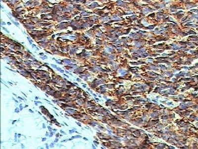 Gastric Carcinoid tumor (5 of 8)