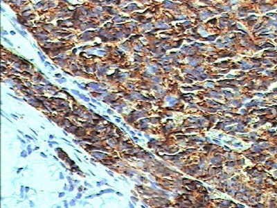 Gastric Carcinoid tumor (5 of 8)