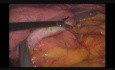 Lymph Leak from Splenogastric Ligament