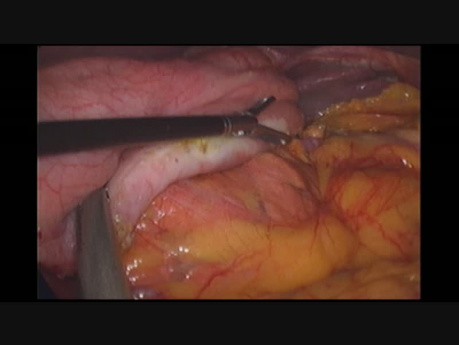 Lymph Leak from Splenogastric Ligament