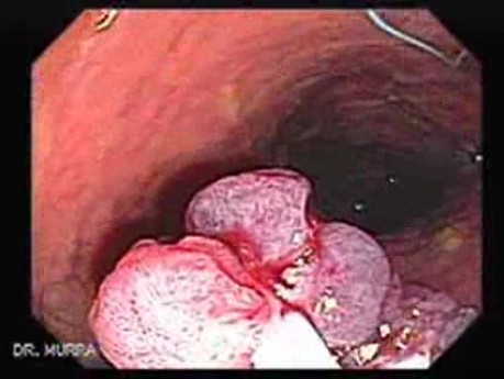 Huge Mass Of The Descending Colon (15 of 25)