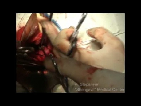 Vaginal Hysterectomy Morcellation