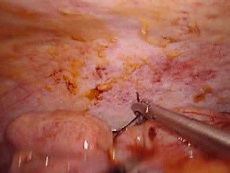 Colonic Perforation With Peritonitis - Laparoscopy (22 of 46)
