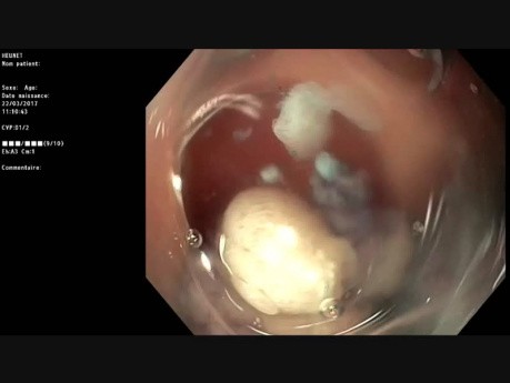 Piece-Meal EMR of a Sigmoid Lesion