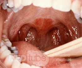 Palatoplasty
