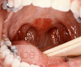 Palatoplasty