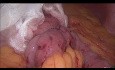 One Anastomosis Gastric Bypass Leak Test